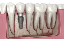 Ağız ve diş sağlığında implant tedavisi