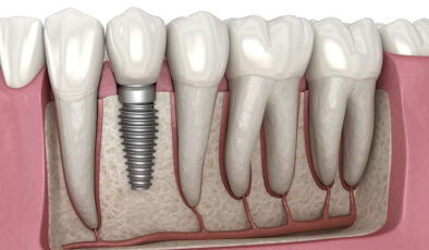 Ağız ve diş sağlığında implant tedavisi
