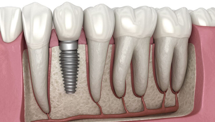 Ağız ve diş sağlığında implant tedavisi