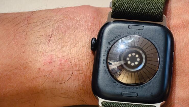 Apple Watch kullanıcıları “cilt tahrişi” şikayetiyle ürünü iade ediyor